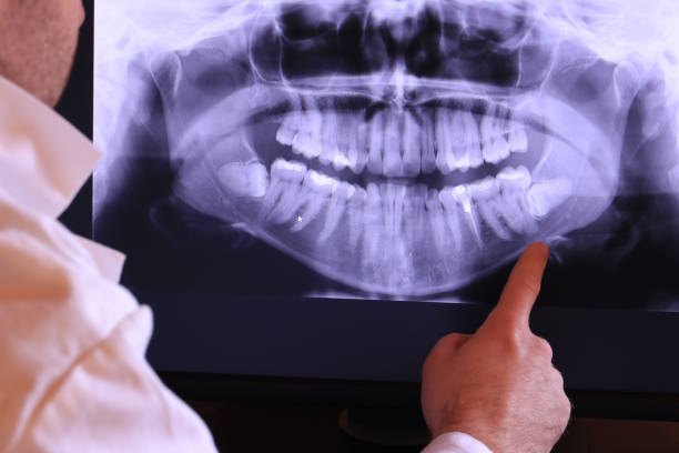 Best Emergency Wisdom Tooth Extraction in Griffith, IN